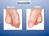 Circuncisión