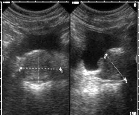 Urología Salamanca Ecografía