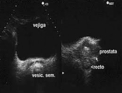 Urología Salamanca Ecografía