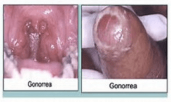 Qué son las enfermedades o infecciones de transmisión sexual - Clínica Urológica. Urología Salamanca. Dr. Miguel Ángel García - Urólogo Salamanca