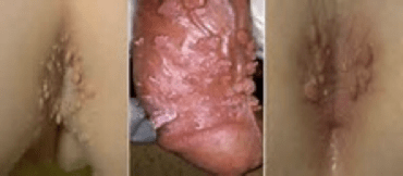 Qué son las enfermedades o infecciones de transmisión sexual - Clínica Urológica. Urología Salamanca. Dr. Miguel Ángel García - Urólogo Salamanca