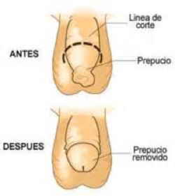 Fimosis - Clínica Urológica. Urología Salamanca. Dr. Miguel Ángel García - Urólogo Salamanca