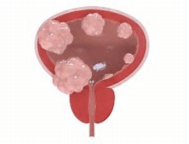 Clínica Urológica. Urología Salamanca. Dr. Miguel Ángel García