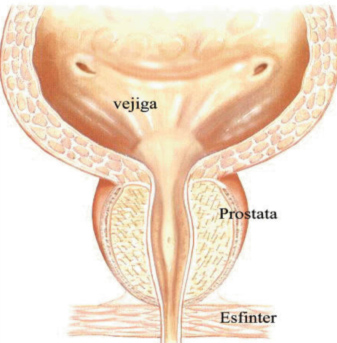 Hiperplasia Benigna de próstata - Clínica Urológica. Urología Salamanca. Dr. Miguel Ángel García - Urólogo Salamanca