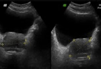 Hiperplasia Benigna de próstata - Clínica Urológica. Urología Salamanca. Dr. Miguel Ángel García - Urólogo Salamanca