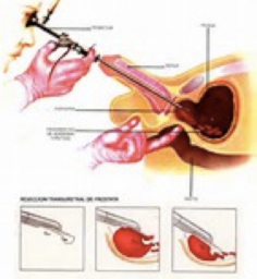 Hiperplasia Benigna de próstata - Clínica Urológica. Urología Salamanca. Dr. Miguel Ángel García - Urólogo Salamanca