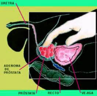 Hiperplasia Benigna de próstata - Clínica Urológica. Urología Salamanca. Dr. Miguel Ángel García - Urólogo Salamanca