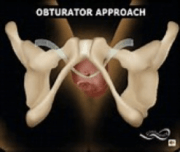 Incontinencia Urinaria Femenina - Clínica Urológica. Urología Salamanca. Dr. Miguel Ángel García - Urólogo Salamanca