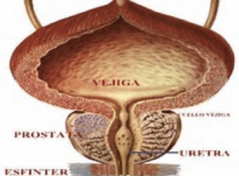 Incontinencia Urinaria Masculina - Clínica Urológica. Urología Salamanca. Dr. Miguel Ángel García - Urólogo Salamanca