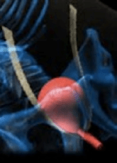 Incontinencia Urinaria Masculina - Clínica Urológica. Urología Salamanca. Dr. Miguel Ángel García - Urólogo Salamanca