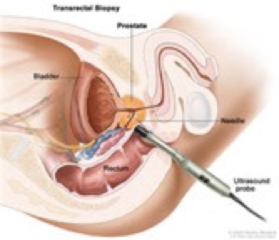 Clínica Urológica. Urología Salamanca. Dr. Miguel Ángel García - Cáncer de próstata