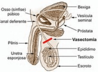 Vasectomía - Clínica Urológica. Urología Salamanca. Dr. Miguel Ángel García - Urólogo Salamanca