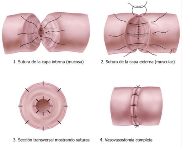 Vaso-vasostomía - Clínica Urológica. Urología Salamanca. Dr. Miguel Ángel García - Urólogo Salamanca